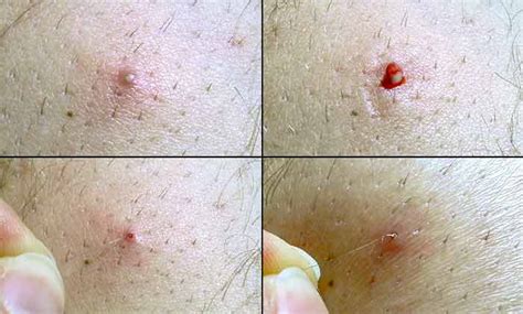 Ingrown Hairs Where They Happen Why And How To Treat Them Contour Dermatology