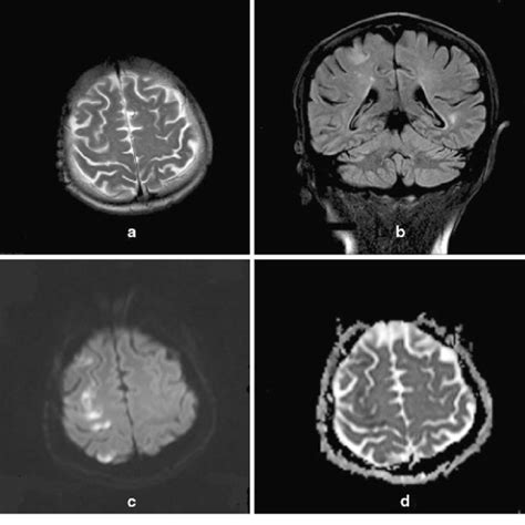 T2 Weighted A Mri And Flair Sequence B Show Cortical Hyperintense Areas