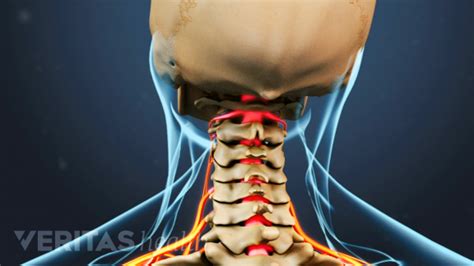Cervical Radiculopathy Causes Symptoms Diagnosis Treatment In