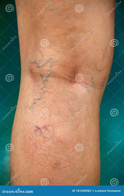 Varicose Veins On The Back Of Knee And Leg In Woman Burred Blue