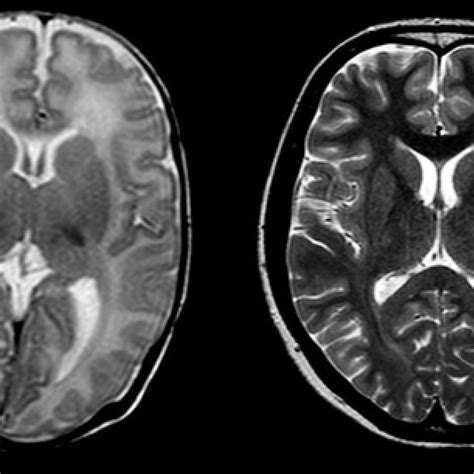 Graphical Comparative Between T2 Mri Image Of Newborn Brain And A Child