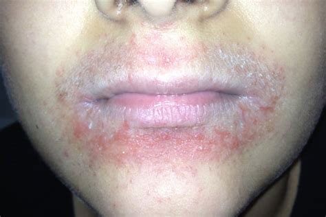 Red Rash Around Lips