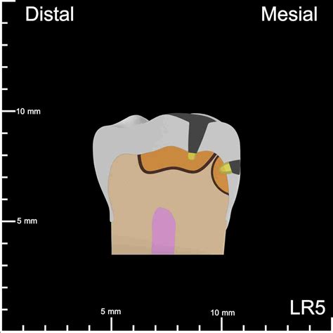 Lr5 Mesial And Occlusal Decay 10k Teeth
