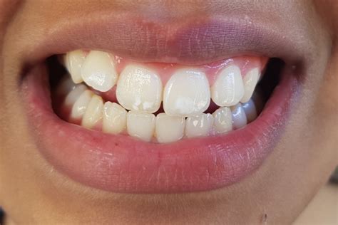 How To Remove White Spots On Teeth At Home Home