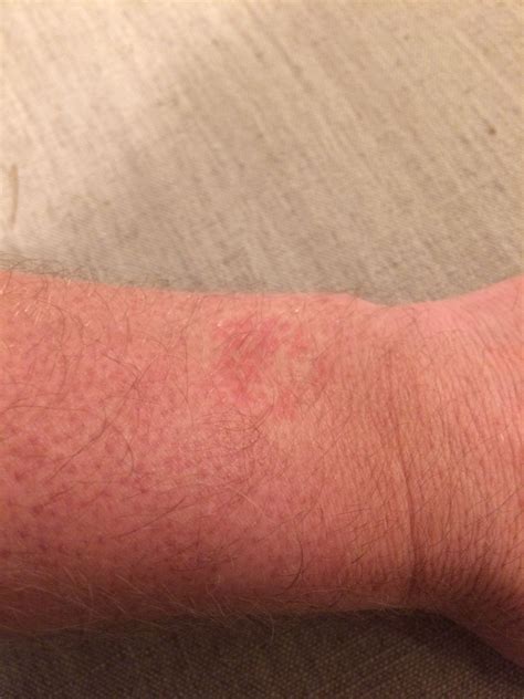 √1000以上 Eczema Rash On Wrist 329558 Contact Dermatitis Rash On Wrist