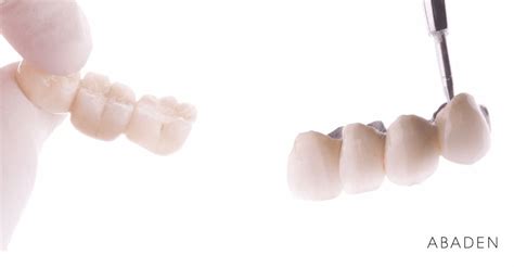 Cuántos tipos de puentes dentales existen Abaden