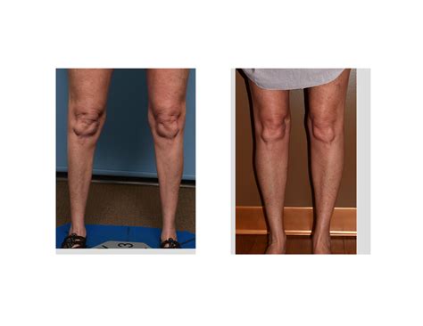 Plastic Surgery Case Study Calf Implants For Female Chicken Legs