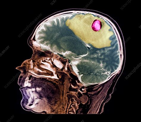 Secondary Brain Cancer Mri Scan Stock Image C0469108 Science