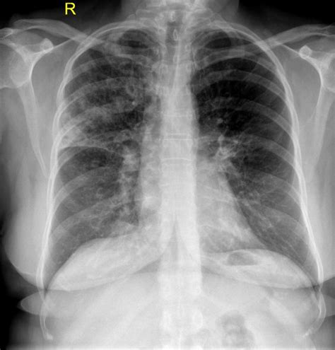 Most infections are due to bacteria or viruses, but some are pneumonia can be life threatening, especially in babies, young children and people older than 60, so. LOBAR PNEUMONIA | buyxraysonline