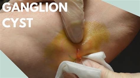 EXPLOSIVE CYST POP It Just Keeps Coming YouTube