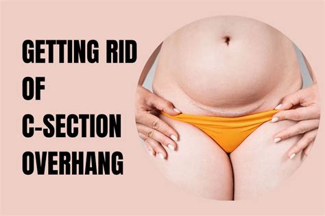 How To Get Rid Of C Section Overhang Without Surgery The Best Non Invasive Treatments Tncore