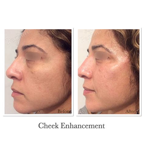 Before And After Cosmetic Treatment Gallery Parfaire Medical Aesthetics