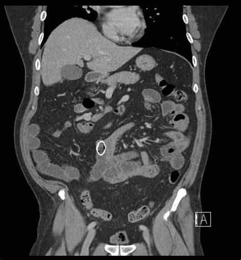 Case Report Midgut Malrotation With Faecolith A Rare Cause Of Small