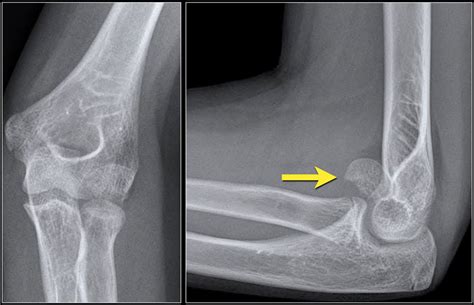 The Radiology Assistant Elbow Fractures In Children