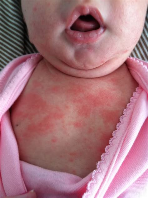 Baby Acne Cure And Treatment Tips To Prevent Baby Heat Rash On Face