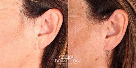 Earlobe Repair Appearance And Function Contour Dermatology