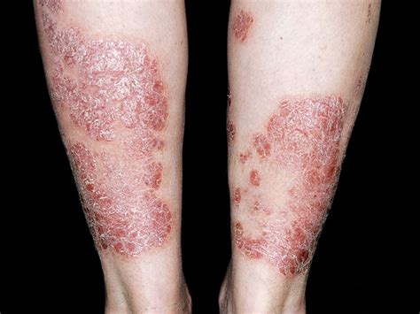 Managing Moderate To Severe Plaque Psoriasis Do You Know Your Options