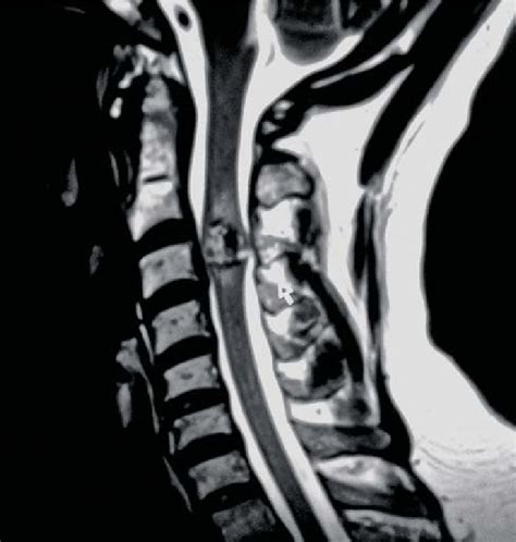 Cervical Spine Mri The T2 Weighted Mid Sagittal View A Reveals A