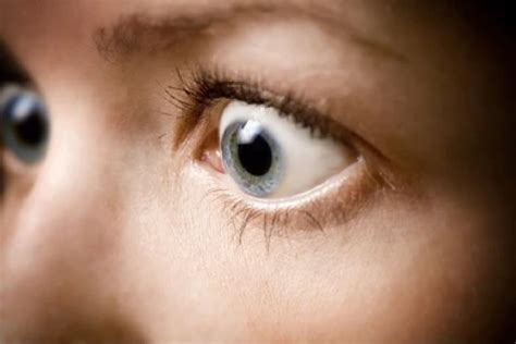Bulging Eyes Exophthalmos Or Proptosis Causes And Treatment