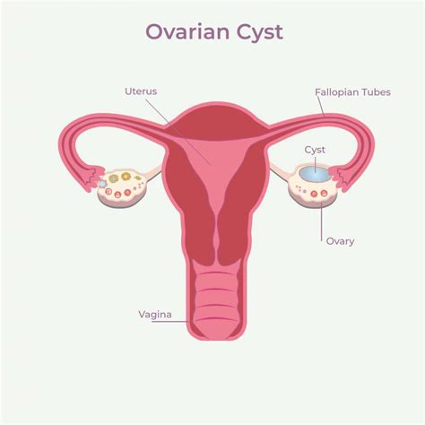 Ovarian Cysts West Sussex Gynaecology