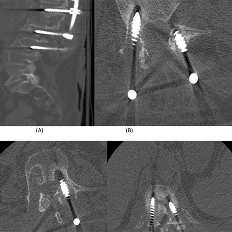 A Sagittal Spine Ct Demonstrating A Burst Fracture Involving L1