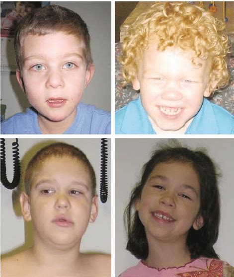 Facial Features Of Fragile X Syndrome As Illustrated By The
