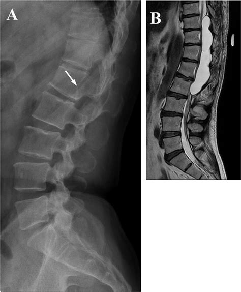 A Lateral Radiographic Image Of The Lumbar Spine Showing The