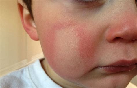 Холодовая аллергия фото симптомы у ребенка на лице у детей и