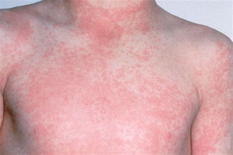 10 Common Skin Rashes In Children Hergamut