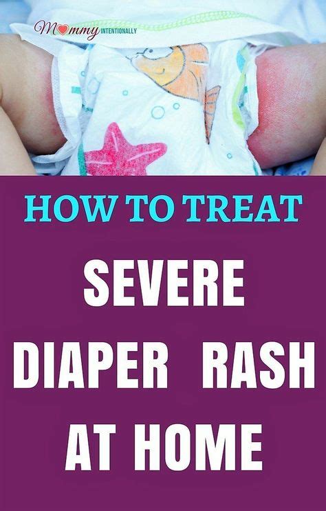 Most Effective Ways Of Treating Diaper Rash In Babies Diaper Rash