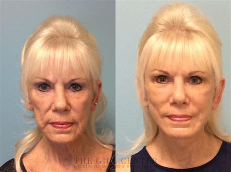 Face Lift And Neck Lift The Woodlands Montgomery Spring Conroe Texas