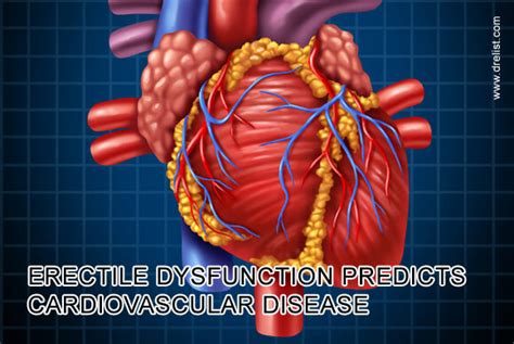 Erectile Dysfunction Predicts Cardiovascular Disease
