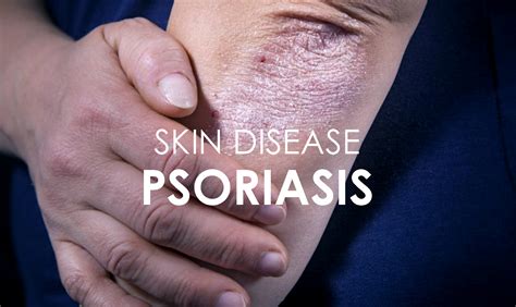 Psoriasis Skin Disease Causes Symptoms And Treatments Premier Clinic