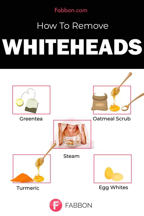 Know What Are Whiteheads And The Home Remedies To Get Rid Of Whiteheads