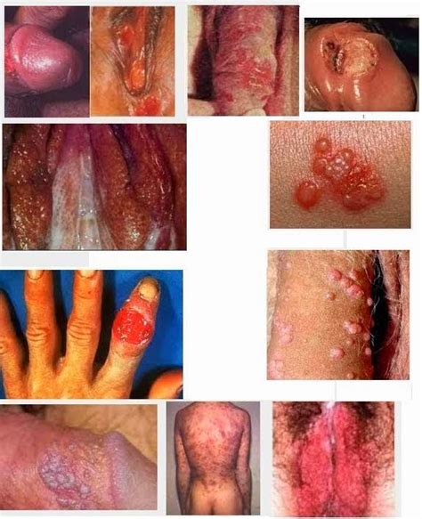 Erick imanuel saputra, jl.pahlawan no 5 rt 5/ rw 4, kabupaten cilacap, jawa tengah 53265, obat. Obat Luka Lecet dan gatal Pada Alat Vital Pria