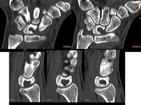 Wrist Arthroscopy Turkey Case Intraosseous Ganglion Cyst Of The Lunate