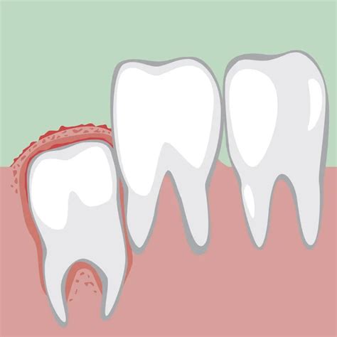 A Wisdom Tooth Grows And The Gums Become Inflamed And Sore A Ve