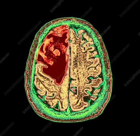 Glioblastoma Brain Cancer Ct Scan Stock Image C0509709 Science