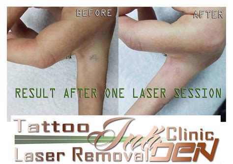 Laser Tattoo Removal This Is The Results After Just One Session