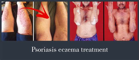 Psoriasis Eczema Treatment Psoriasis Expert