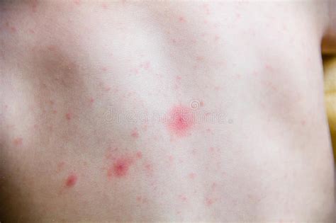 A child who has a tummy ache or if your baby has mild to moderate eczema: Baby With Dermatitis Problem Of Rash. Allergy Rash ...