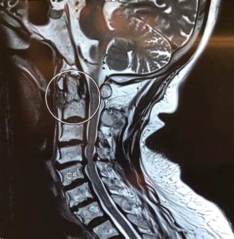 Severe Neck Injury The Hong Kong Chiropractor And Neurosurgeon