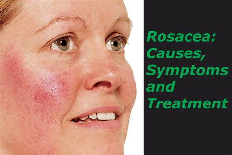 Rosacea Causes Symptoms And Treatments 2020