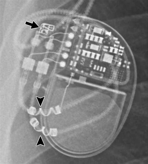 Radiography Of Pacemakers And Implantable Cardioverter Defibrillators Ajr