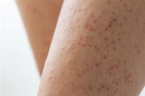 Understanding And Treating Keratosis Pilaris Achieving Smoother Skin