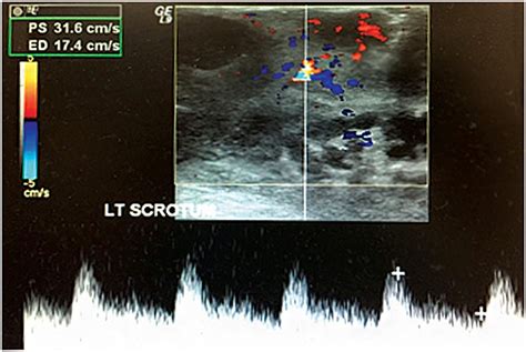 Trichilemmal Cysts Of The Scrotal Wall Biddle 2015 Sonography
