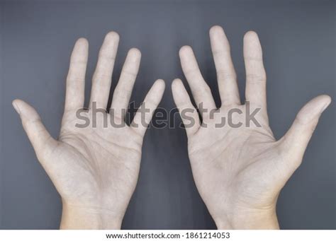 Pale Palmar Surface Both Hands Anaemic Stock Photo 1861214053