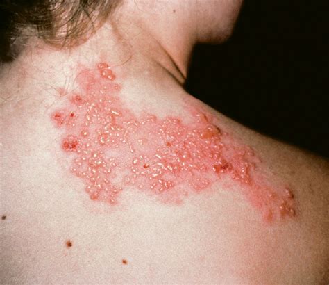Fotos De Herpes Zoster