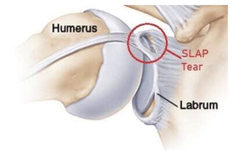 It can be caused by a shoulder injury or just from simple everyday over use of ones. Shoulder Labral Tears | Eastside Medical Group