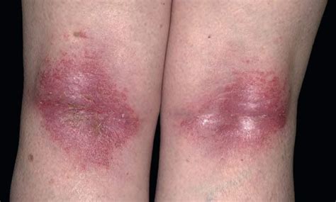 Dermatita Atopica Cauze Simptome Preventie Tratament Sexiezpicz Web Porn
